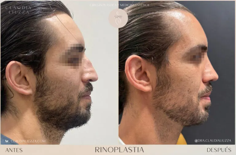 Otoplastia