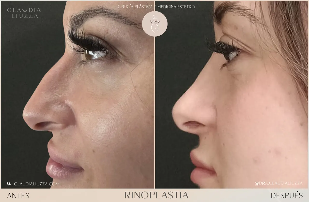 Rinoplastia ultrasónica