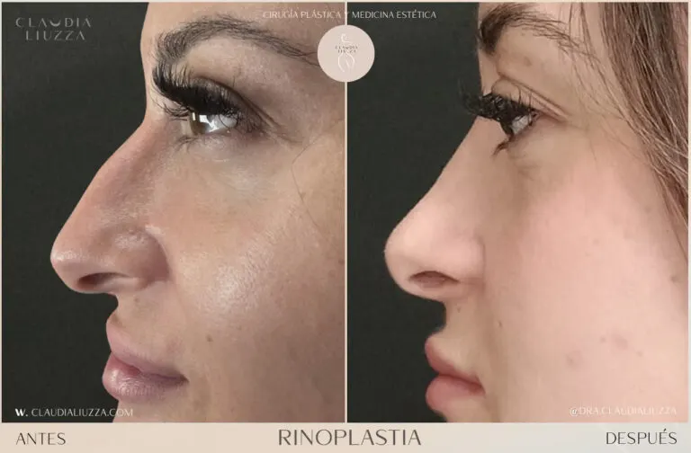 Rinoplastia ultrasónica